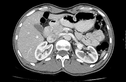 ct-abdomen-computertomographie