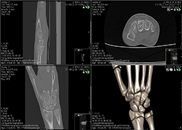 ct-hand-computertomographie