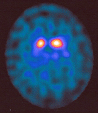 hirn-spect-mit-parkinson2