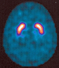 hirn-spect-ohne-parkinson2