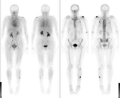 skelettszintigraphie1