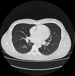 thorax-nuklearmedizin