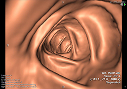 ct-colonographie1