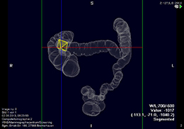 ct-colonographie2